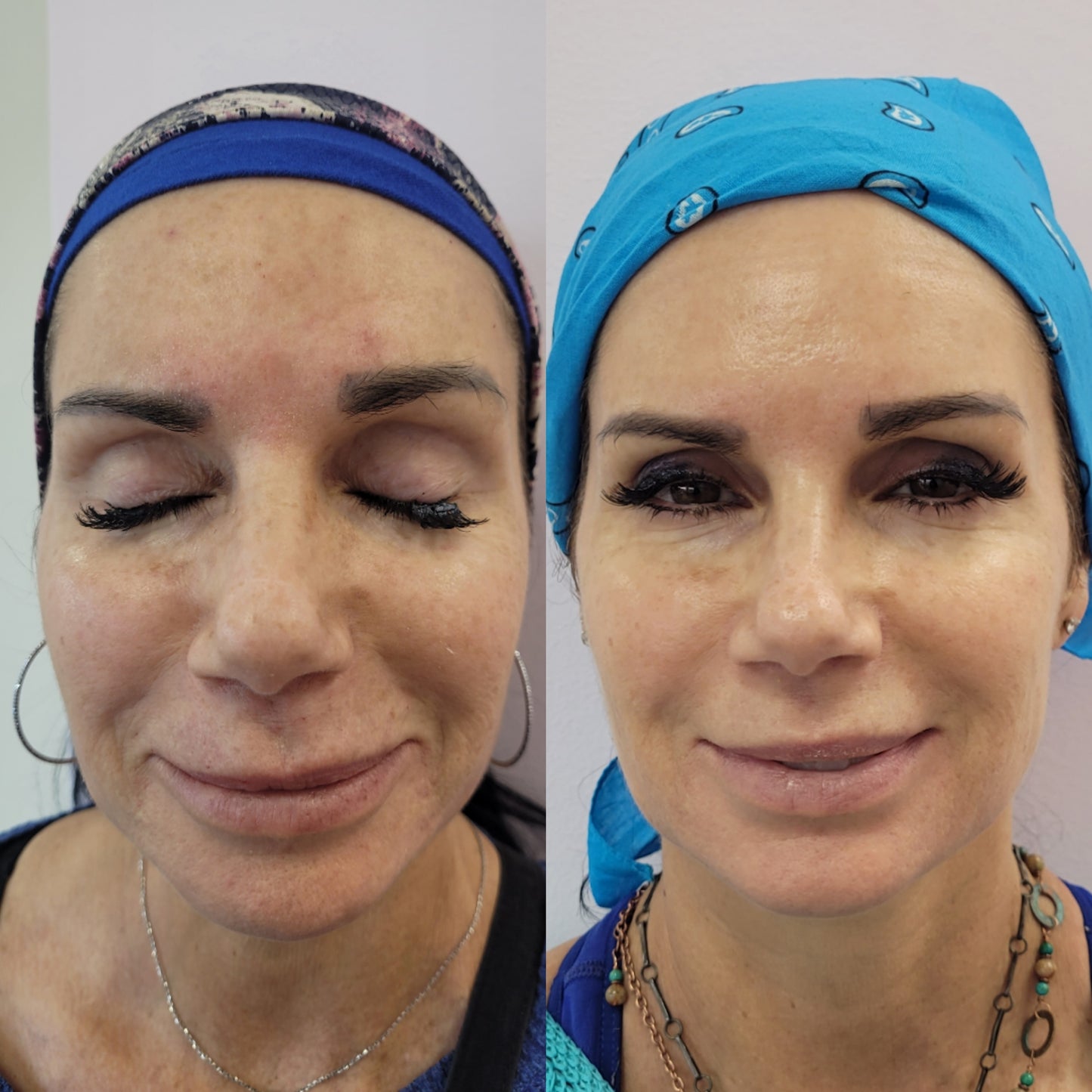 kojic acid serum